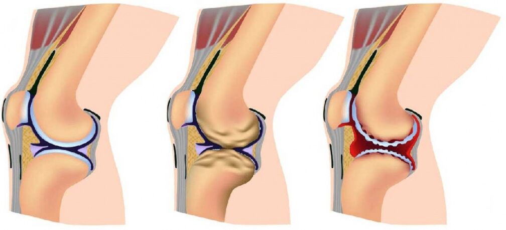 Healthy joint and osteoarthritis affected