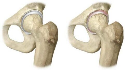 healthy hip joint affected by osteoarthritis